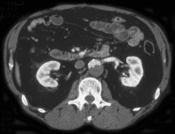 Aortic Dissection - CTisus CT Scan