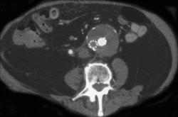 Thrombosed Limb of An Endovascular Graft - CTisus CT Scan