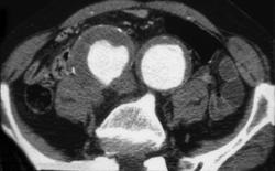 Iliac Artery Aneurysm - CTisus CT Scan