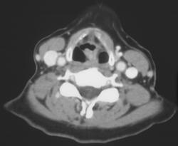 Flow Changes Simulate A Left Jugular Vein Thrombosis - CTisus CT Scan