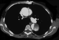 Aortic Dissection - CTisus CT Scan