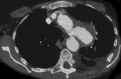 Ductus Aneurysm - CTisus CT Scan