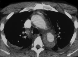 Hematoma in the Wall of the Aorta - CTisus CT Scan