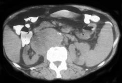 Mycotic Aneurysm - CTisus CT Scan