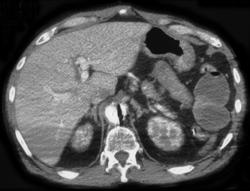 Balloon Pump in Aorta - CTisus CT Scan