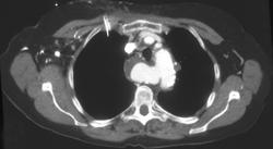 Aneurysm of Aberrant Right Subclavian Artery - CTisus CT Scan