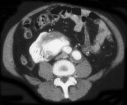 Leaking Aortic Aneurysm - CTisus CT Scan