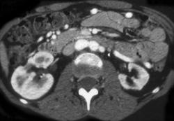 Stenosis of Both Renal Arteries With Post Stenotic Dilation - CTisus CT Scan