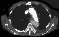 Aortic Dissection - CTisus CT Scan