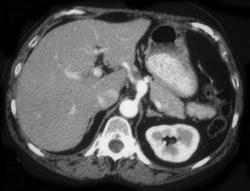 Celiac Artery Aneurysms - CTisus CT Scan