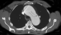 Aortic Dissection Into Left Subclavian Artery - CTisus CT Scan