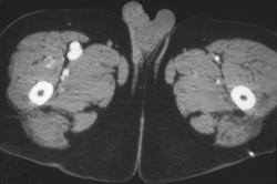 Arteriovenous (AV) Fistulae on the Right Side - CTisus CT Scan