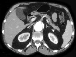 Aortic Dissection - CTisus CT Scan