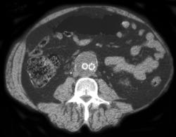 Endovascular Graft (c-/c+) - CTisus CT Scan