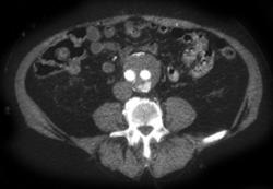 Endovascular Graft - CTisus CT Scan