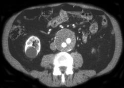 Endovascular Graft With A Leak - CTisus CT Scan