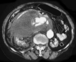 Leaking Abdominal Aortic Aneurysm - CTisus CT Scan