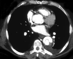 Aortic Dissection - CTisus CT Scan