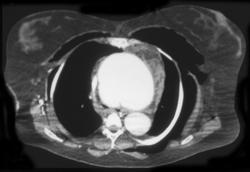 Aortic Dilation in Ehlers-Danlos Syndrome - CTisus CT Scan