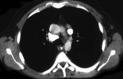 Persistent Left Superior Vena Cava (SVC) - CTisus CT Scan