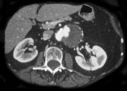 Mycotic Aortic Aneurysm - CTisus CT Scan