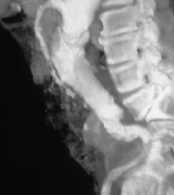 Dilation at Origin of SMA - CTisus CT Scan