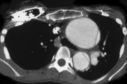 Aortic Dissection - CTisus CT Scan