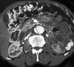 Aortic Dissection With Decreased Flow to the Left Kidney - CTisus CT Scan