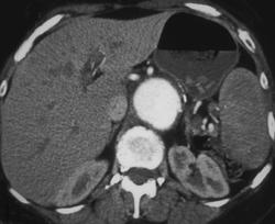 Aortic Aneurysm - CTisus CT Scan