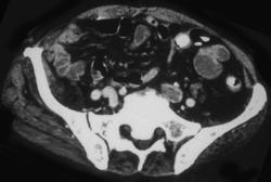 Thrombosed Left Iliac Vein - CTisus CT Scan