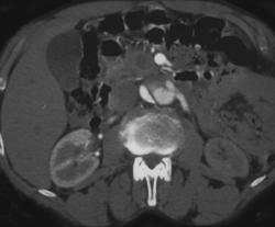 Aortic Dissection - CTisus CT Scan