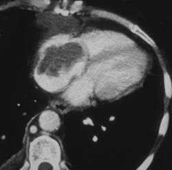 Cardiac Lymphoma - CTisus CT Scan