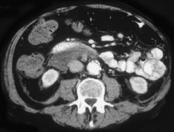 Bleed From Aortic Aneurysm - CTisus CT Scan