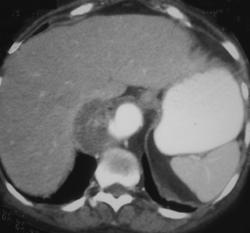 Ulcerating Aneurysm - CTisus CT Scan