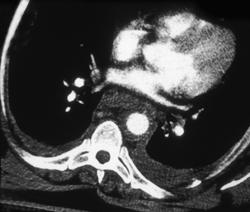 Traumatic Dissection (MVA) - CTisus CT Scan