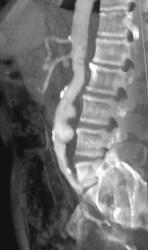 Focal Ulcerations in Aorta - CTisus CT Scan