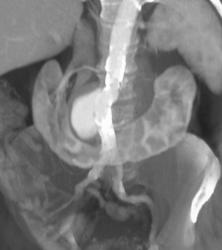 Mycotic Aneurysm (horseshoe Kidneys Also) - CTisus CT Scan