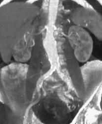 Aortic Aneurysm - CTisus CT Scan