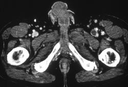 Left Femoral Vein Thrombosis - CTisus CT Scan