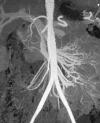 Normal SMA - CTisus CT Scan