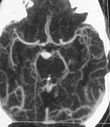 Intracranial Aneurysm - CTisus CT Scan