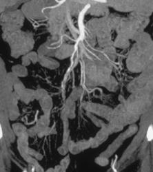 Stenosis of Branches of the SMA - CTisus CT Scan