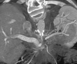 Celiac Artery Stenosis at Origin - CTisus CT Scan