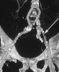 Narrowed Left External Iliac Artery - CTisus CT Scan