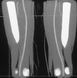 Nice 3D of Popliteal Vessels - CTisus CT Scan