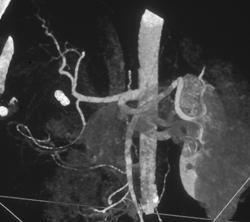 Normal Hepatic Artery - CTisus CT Scan