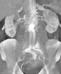 Sharp Angulation of Stent Graft - CTisus CT Scan