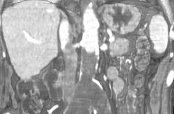 Thrombosed Lower Abdominal Aorta - CTisus CT Scan