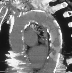 Extensive Calcified Plaque in Aorta - CTisus CT Scan