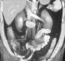 Normal Colonic Branches of SMA - CTisus CT Scan